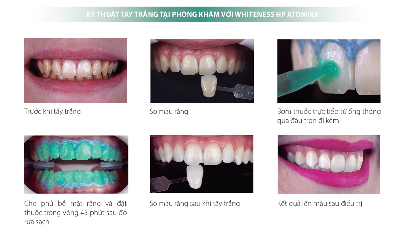 Tay-trang-rang-whiteness-hp-automixx