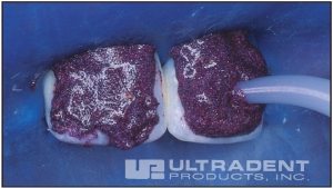20-17-opalustre-hd-ULTRADENT