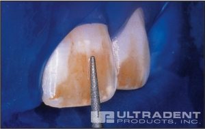 20-16-opalustre-hd-ULTRADENT