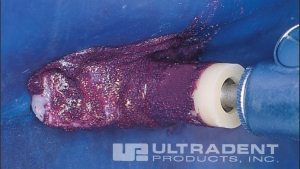 20-18-opalustre-hd-ULTRADENT