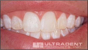 20-19-opalustre-hd-ULTRADENT