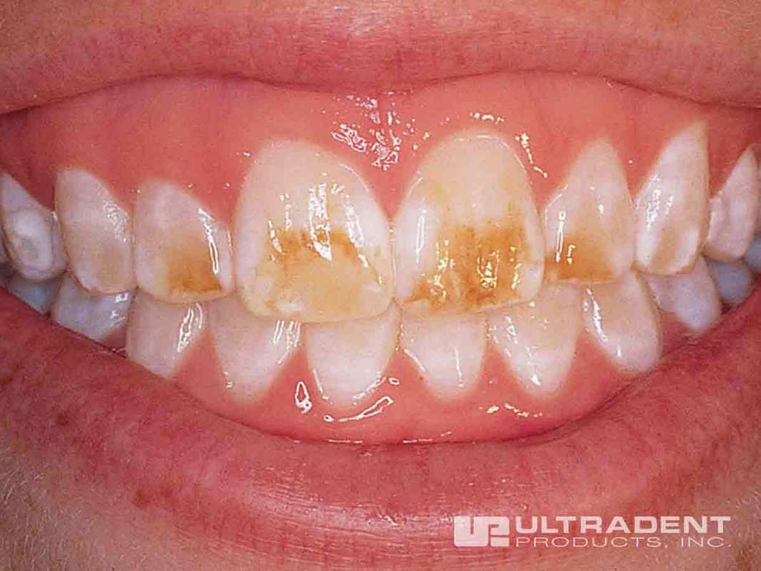 1_Opalustre-Procedure-with-rubber-dam