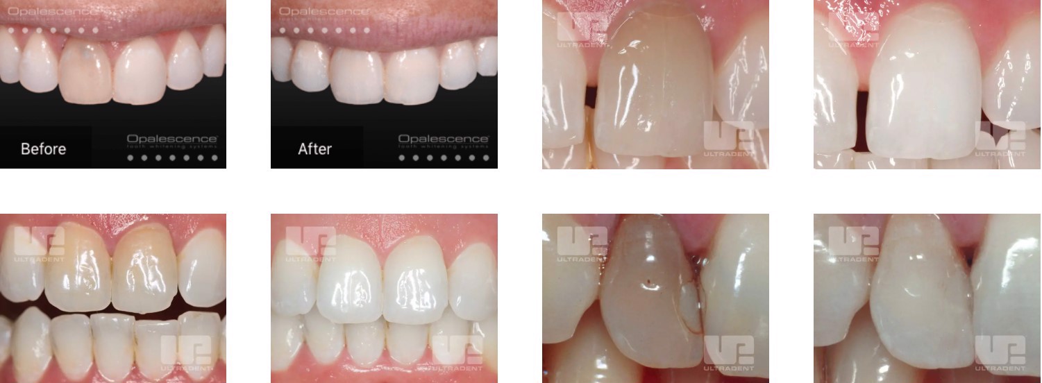 Opalescence-Endo (2)