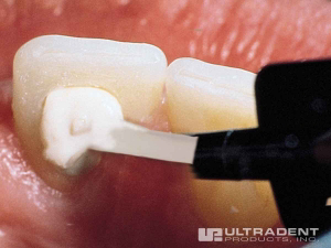 2_Opalescence-Endo-Procedure