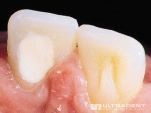 4_Opalescence-Endo-Procedure