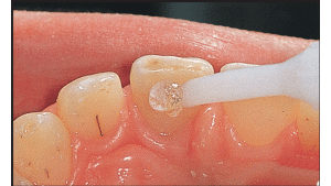 19-11---ULTRADENT