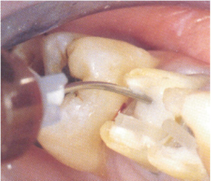 144-4-Permaflor-ULTRADENT