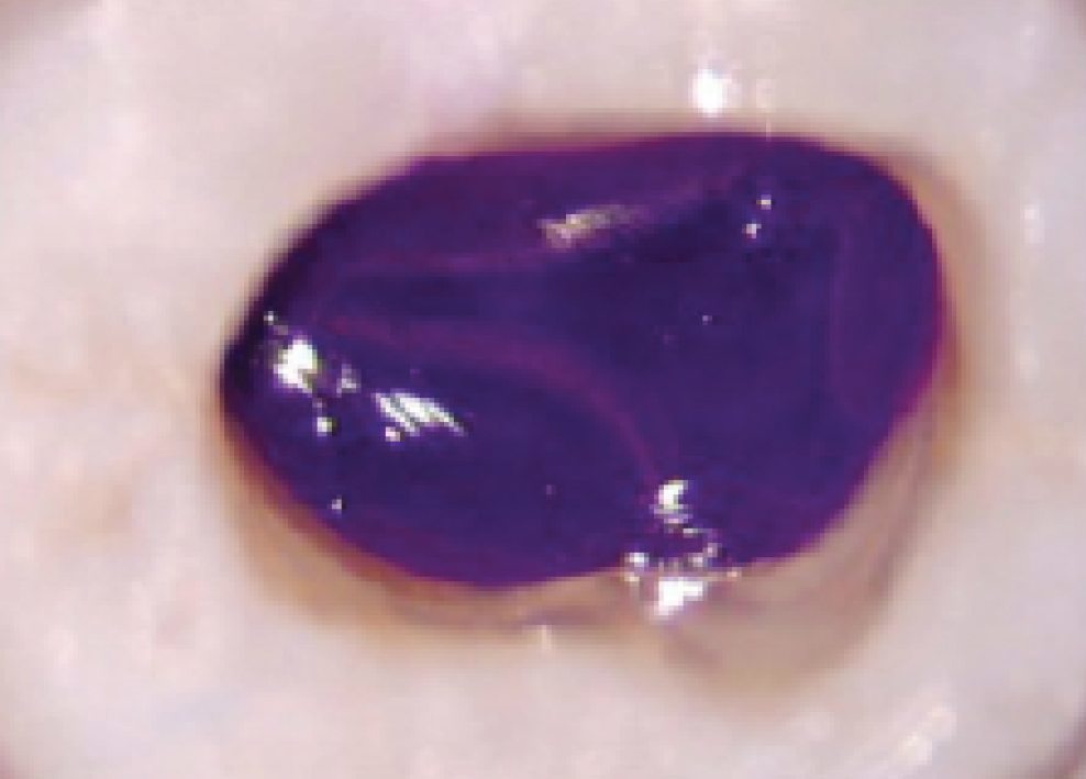 144-10-Permaflor-ULTRADENT