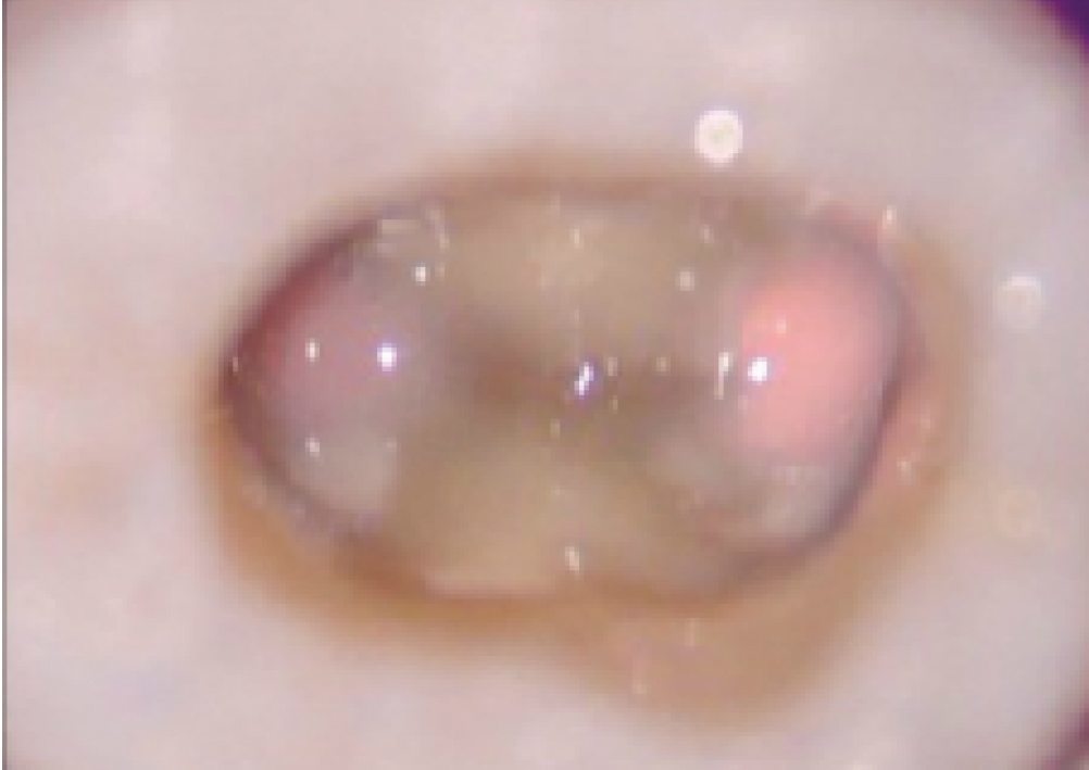 144-9-Permaflor-ULTRADENT