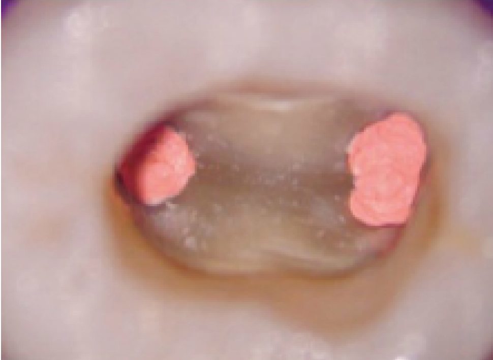 144-8-Permaflor-ULTRADENT