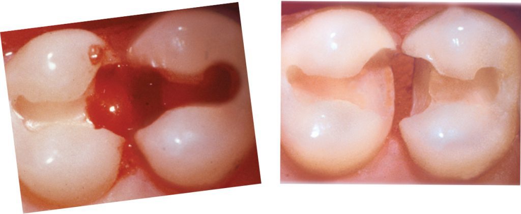 147-2-Viscostat-ULTRADENT