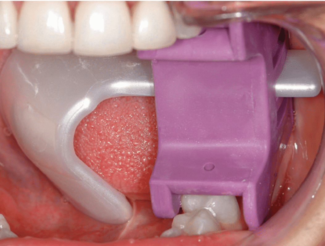 52-3-propguard-&-tonguard-ULTRADENT