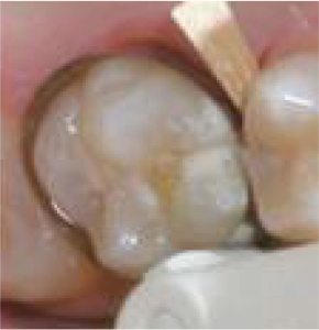 51-8-Omni-matrix-ULTRADENT