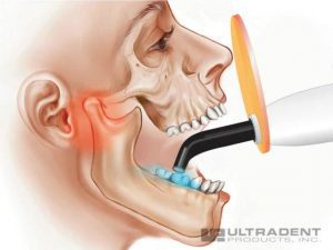 so sánh đèn trám valo