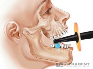 so sánh đèn trám valo