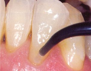 44-3-dentin-sealant--ULTRADENT