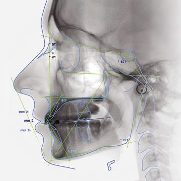 Planmeca-Ceph-phân-tích-sọ-nghiêng