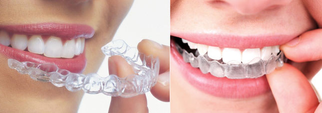 essix plastic