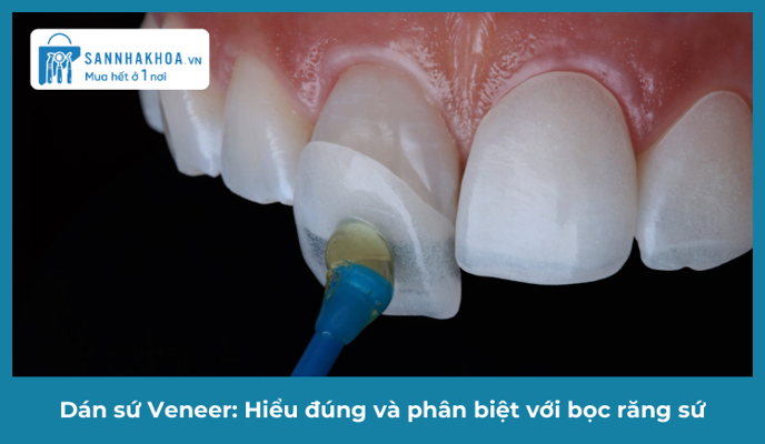 Dán sứ Veneer: Hiểu đúng và phân biệt với bọc răng sứ