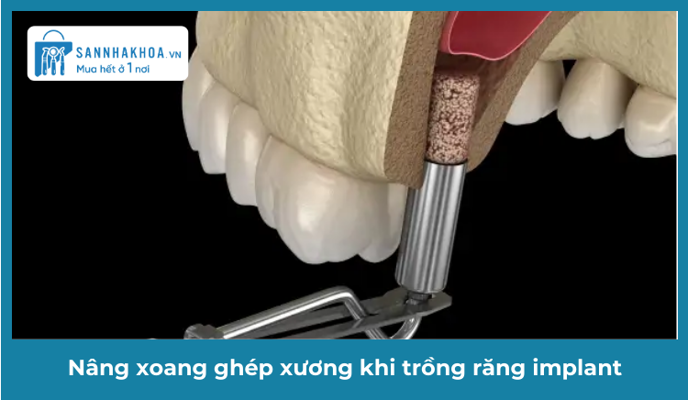 Nâng xoang ghép xương khi trồng răng implant