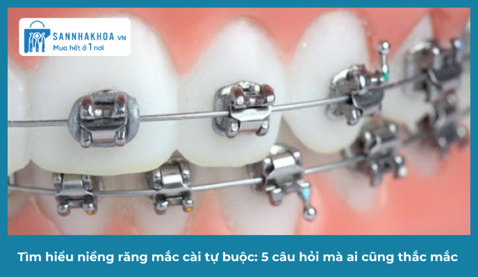 Tìm Hiểu Niềng Răng Mắc Cài Tự Buộc: 5 Câu Hỏi Mà Ai Cũng Thắc Mắc
