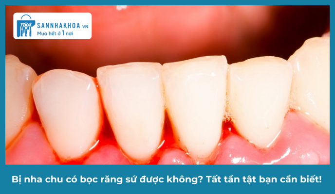 Bị nha chu có bọc răng sứ được không? Tất tần tật bạn cần biết!
