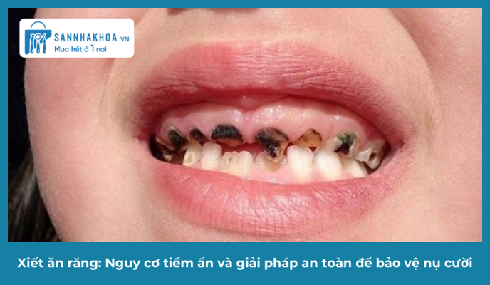 Xiết ăn răng: Nguy cơ tiềm ẩn và giải pháp an toàn để bảo vệ nụ cười