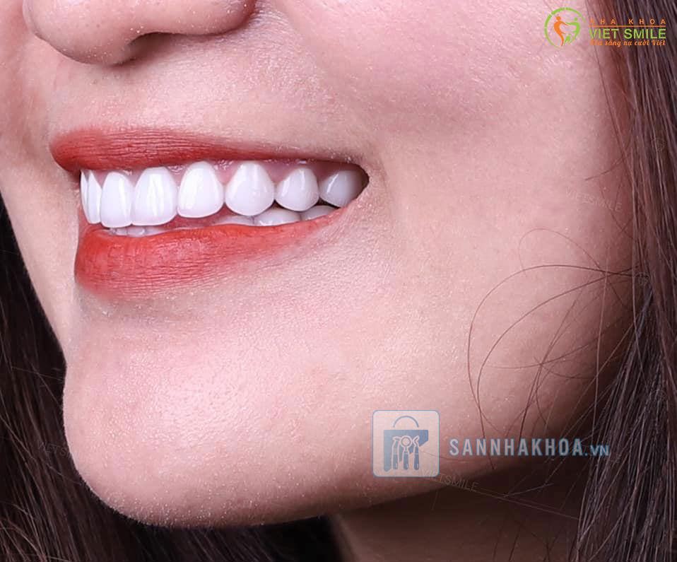 Mài răng bọc sứ sai cách: Tác hại và những thông tin cần biết