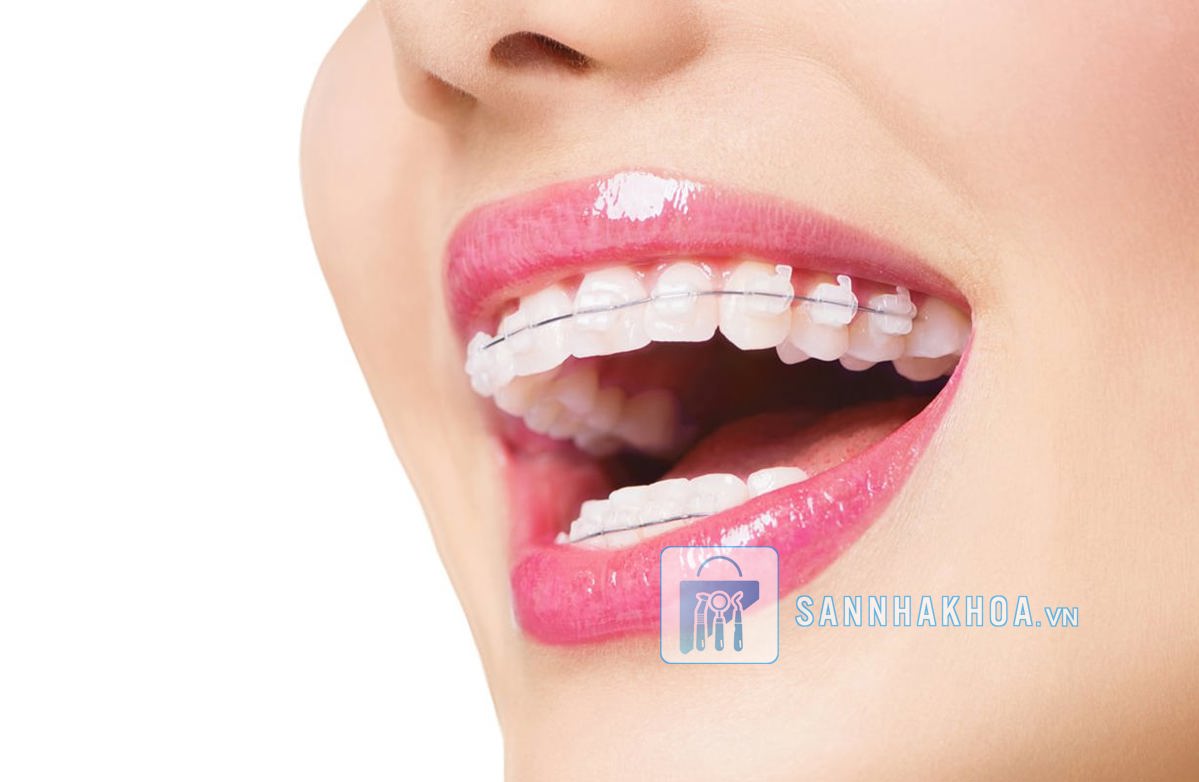 Vì sao niềng răng cần chăm sóc răng miệng đặc biệt?