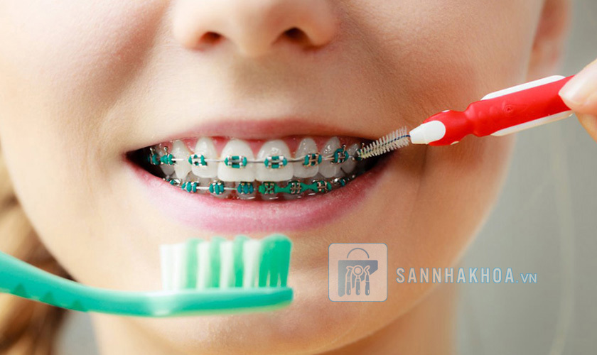 Hướng dẫn chăm sóc răng miệng đúng cách khi niềng răng