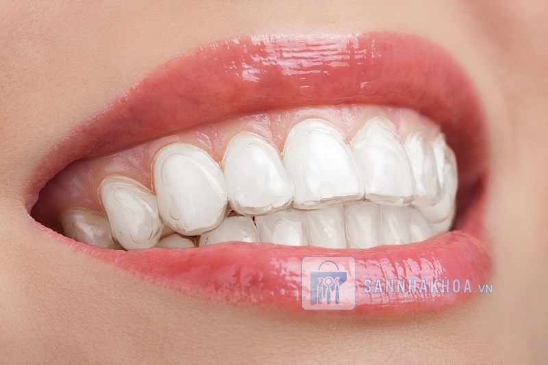 Bật mí các phương pháp tẩy trắng răng: Bạn đã chọn đúng cách?