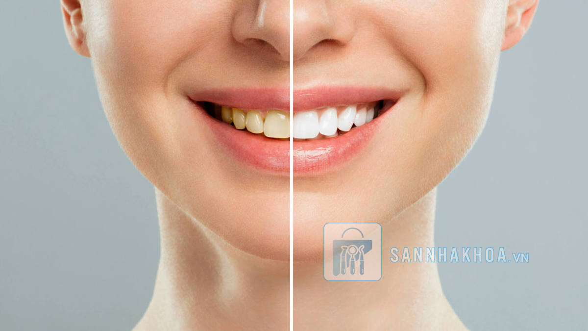 Bật mí các phương pháp tẩy trắng răng: Bạn đã chọn đúng cách?