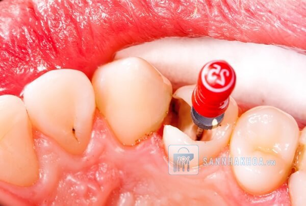 Lấy tủy răng: Quy trình, chi phí và những điều cần biết