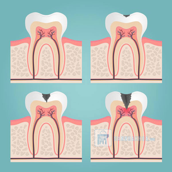 Lấy tủy răng: Quy trình, chi phí và những điều cần biết