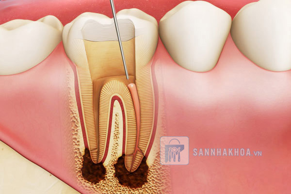 Lấy tủy răng: Quy trình, chi phí và những điều cần biết