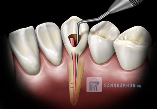 Lấy tủy răng: Quy trình, chi phí và những điều cần biết