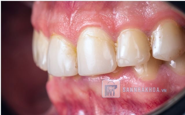 Bị nha chu có bọc răng sứ được không? Tất tần tật bạn cần biết!