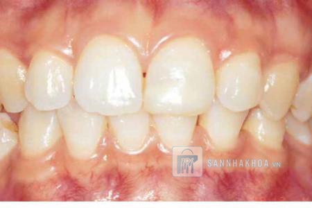 Bị nha chu có bọc răng sứ được không? Tất tần tật bạn cần biết!