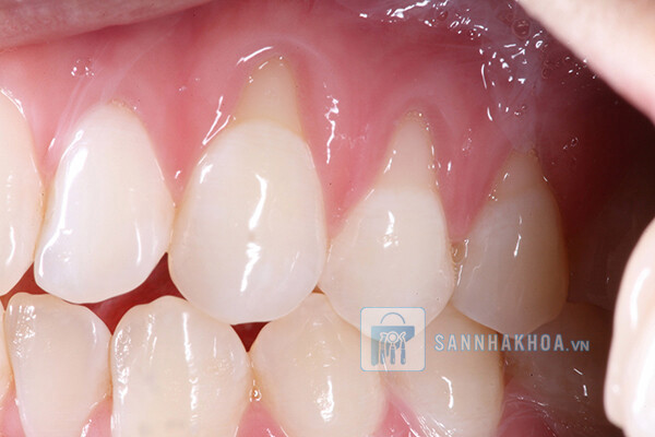 Tụt nướu: Nguyên nhân, triệu chứng và cách điều trị hiệu quả