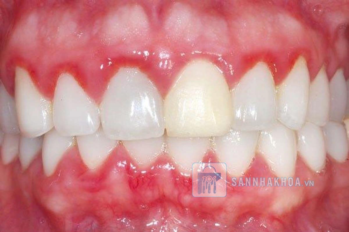 Tụt nướu: Nguyên nhân, triệu chứng và cách điều trị hiệu quả