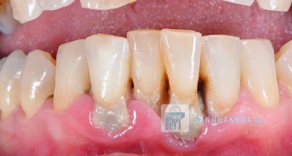 Tụt nướu: Nguyên nhân, triệu chứng và cách điều trị hiệu quả