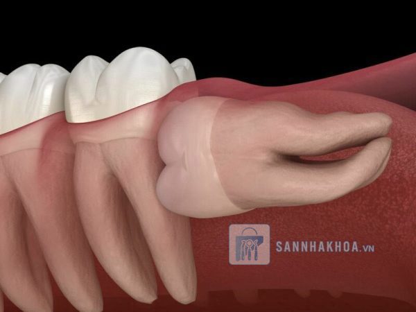 Có nên nhổ răng nanh mọc ngầm không?