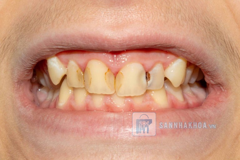 Trám răng cửa: Những trường hợp phải biết để bảo vệ nụ cười Trám răng cửa: Những trường hợp phải biết để bảo vệ nụ cười