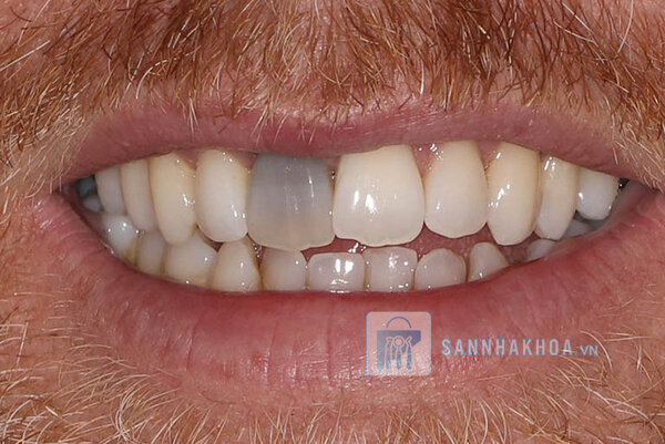 Trám răng cửa: Những trường hợp phải biết để bảo vệ nụ cười Trám răng cửa: Những trường hợp phải biết để bảo vệ nụ cười