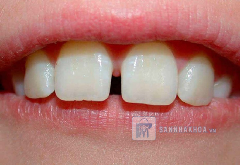 Trám răng cửa: Những trường hợp phải biết để bảo vệ nụ cười Trám răng cửa: Những trường hợp phải biết để bảo vệ nụ cười