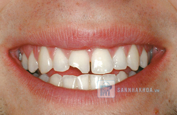 Trám răng cửa: Những trường hợp phải biết để bảo vệ nụ cười Trám răng cửa: Những trường hợp phải biết để bảo vệ nụ cười