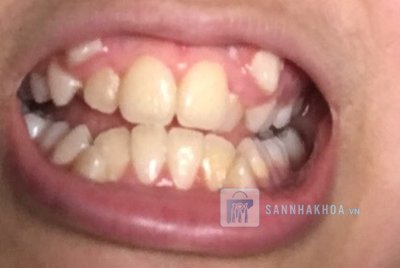 Chỉnh răng mọc lệch có cần niềng không?