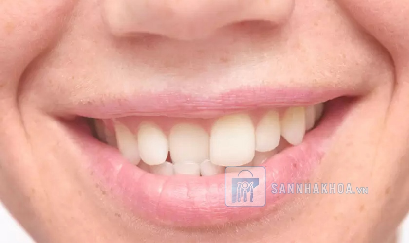 Cách chỉnh răng mọc lệch không cần niềng răng tại nhà