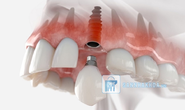 Trồng răng implant giá rẻ: 5 tác hại bạn có thể gặp phải