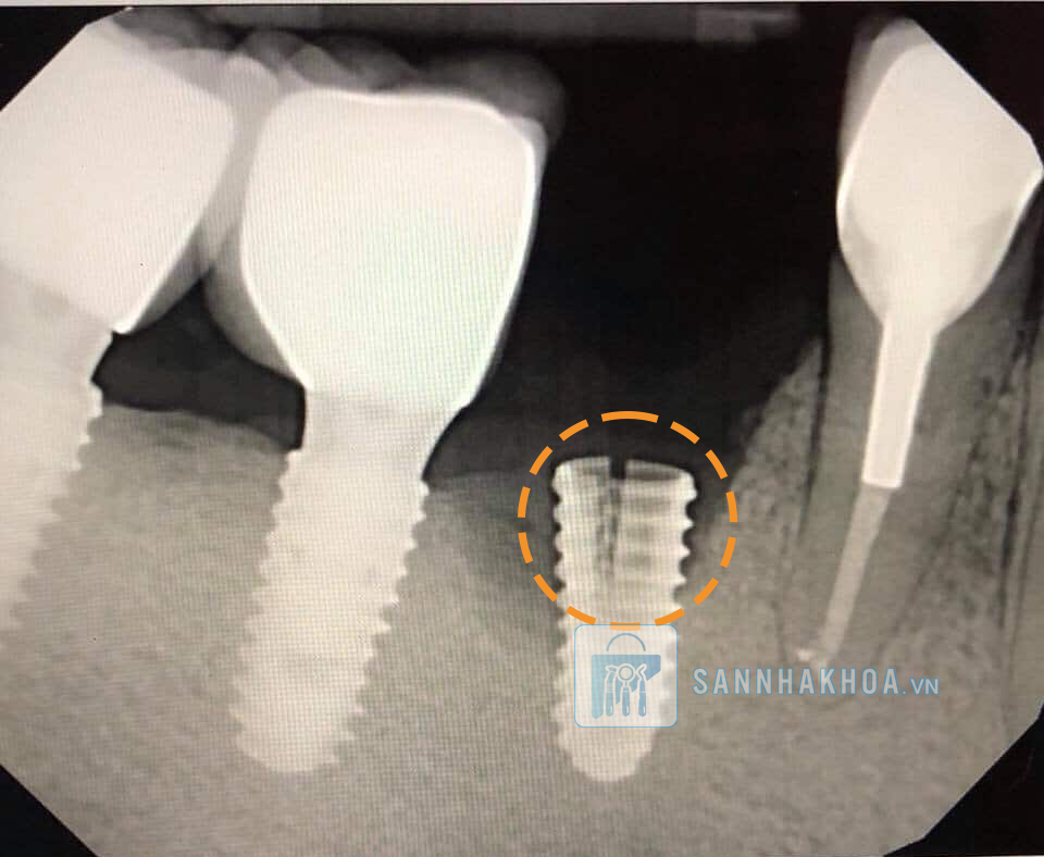 Trồng răng implant giá rẻ: 5 tác hại bạn có thể gặp phải